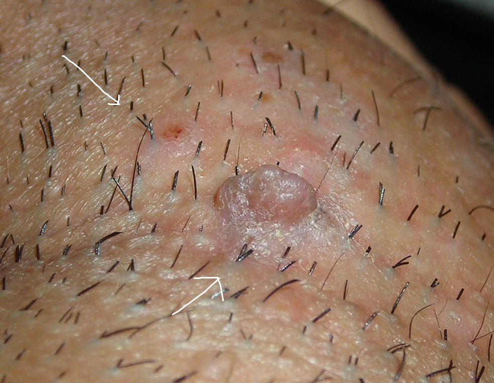 Is this Genital Warts, moles, Skin Tags or molluscum contagiosum? | Skin  Growths and Pigment Disorders discussions | Body & Health Conditions center  